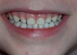 pourquoi l'enfant grince des dents