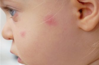 piqûres d'insectes chez les enfants